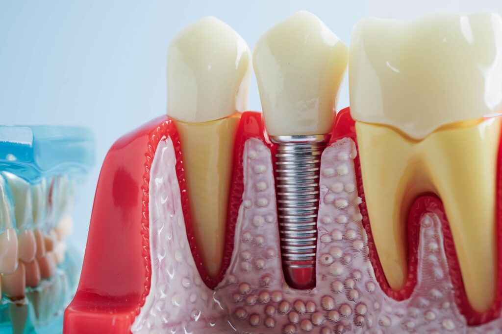 Dental Implants rutherford