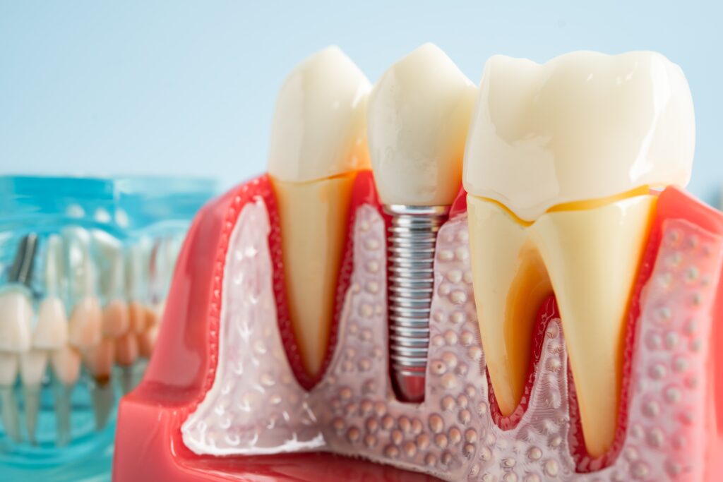 dental implants near me